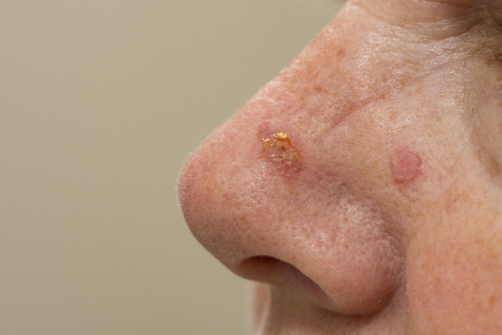 Basal Cell Carcinoma on the nose