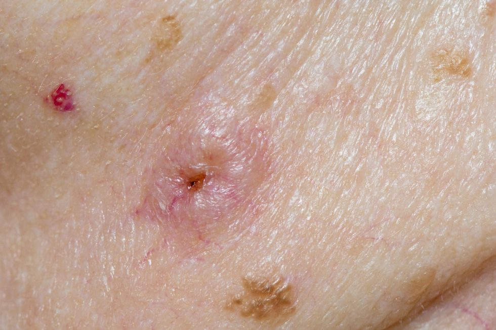 Squamous Cell Carcinoma picture